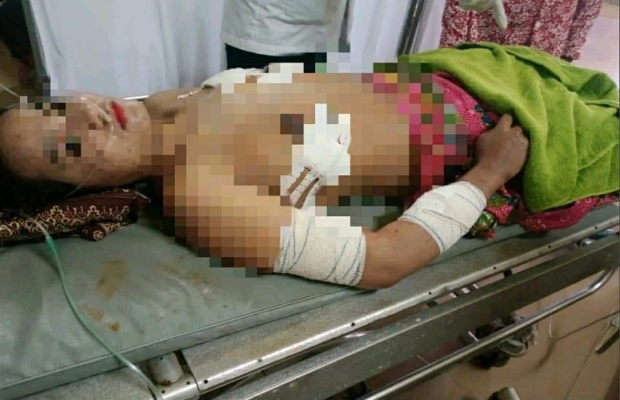 យ៉ាងសាហាវព្រៃផ្សៃណាស់!ព្រោះតែភ្លើងប្រច័ណ្ឌប្តីហានទាញដែកចំពុះទុងចាក់ប្រពន្ធខ្លួនឯងបណ្តាលឲ្យរងរបួសធ្ងន់...!